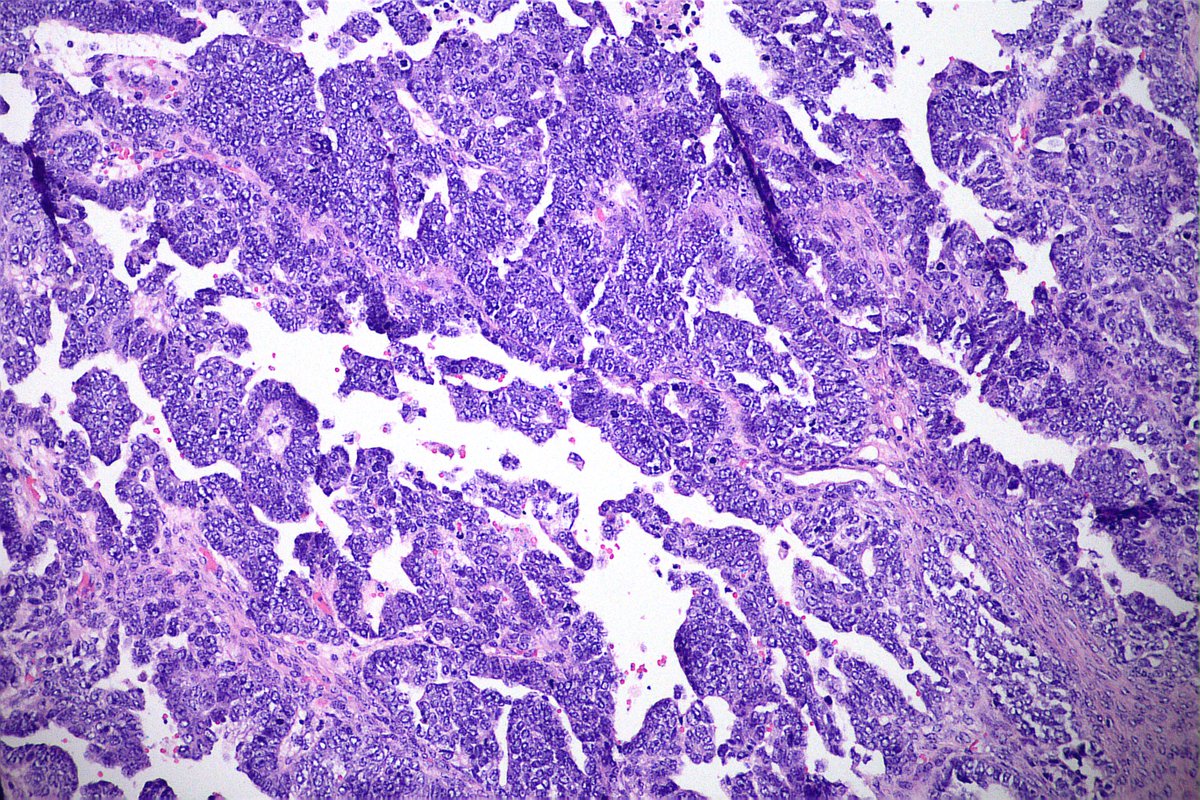 GeronimoJrLapac's tweet image. 65-year-old patient with bilateral ovarian tumor and omentum implant. Almost all of the avaries with Ca serous morphology and this abrupt focus (last 2 pics). What do you think?
#gynpath