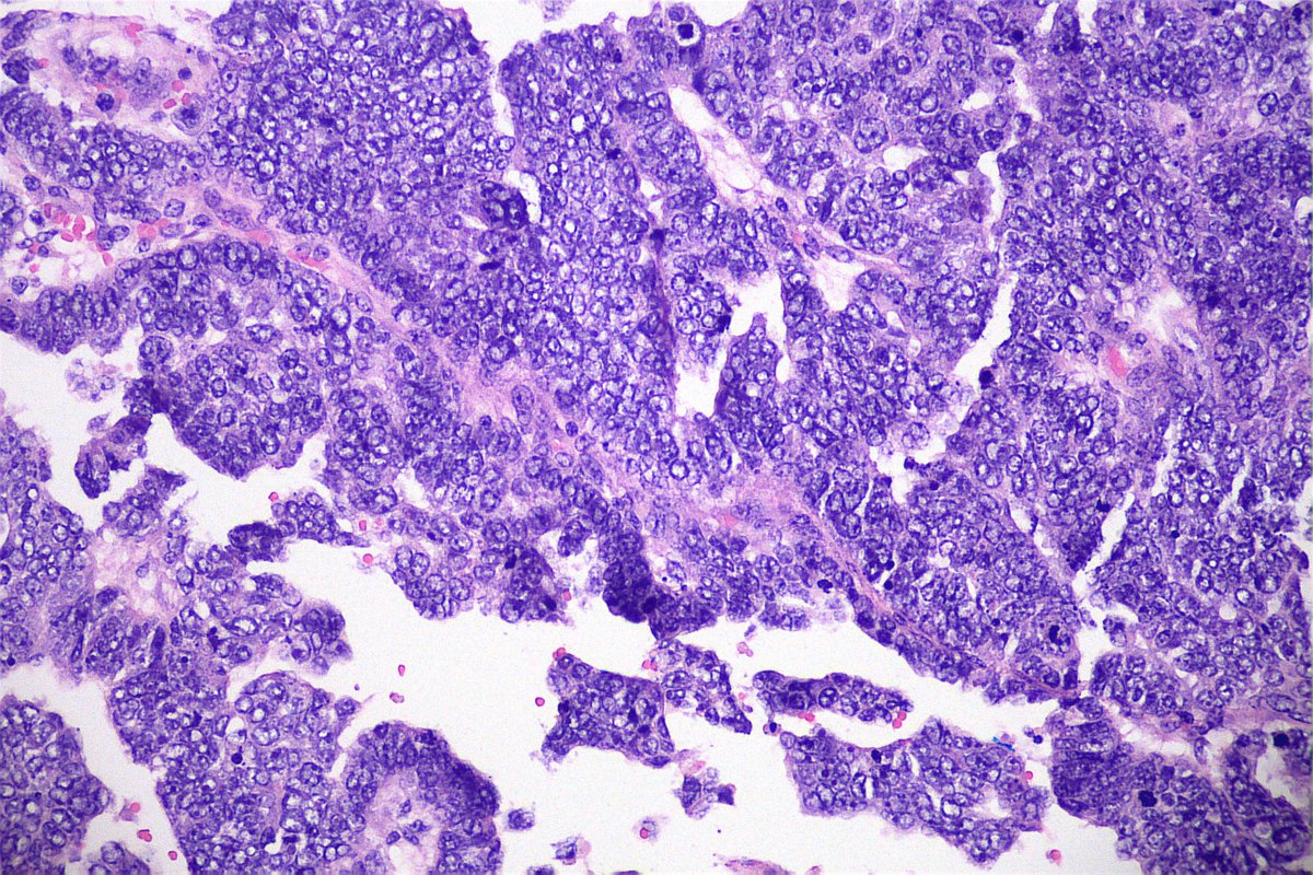 GeronimoJrLapac's tweet image. 65-year-old patient with bilateral ovarian tumor and omentum implant. Almost all of the avaries with Ca serous morphology and this abrupt focus (last 2 pics). What do you think?
#gynpath