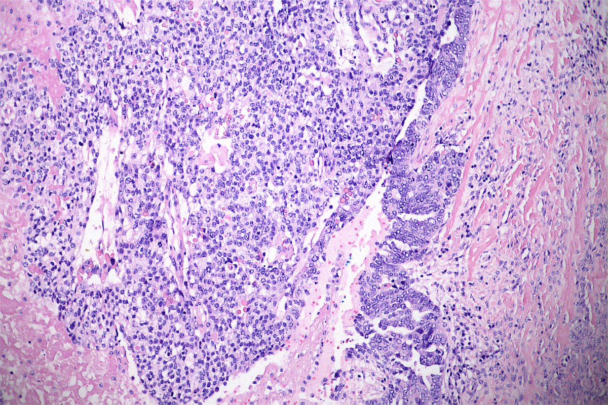 GeronimoJrLapac's tweet image. 65-year-old patient with bilateral ovarian tumor and omentum implant. Almost all of the avaries with Ca serous morphology and this abrupt focus (last 2 pics). What do you think?
#gynpath