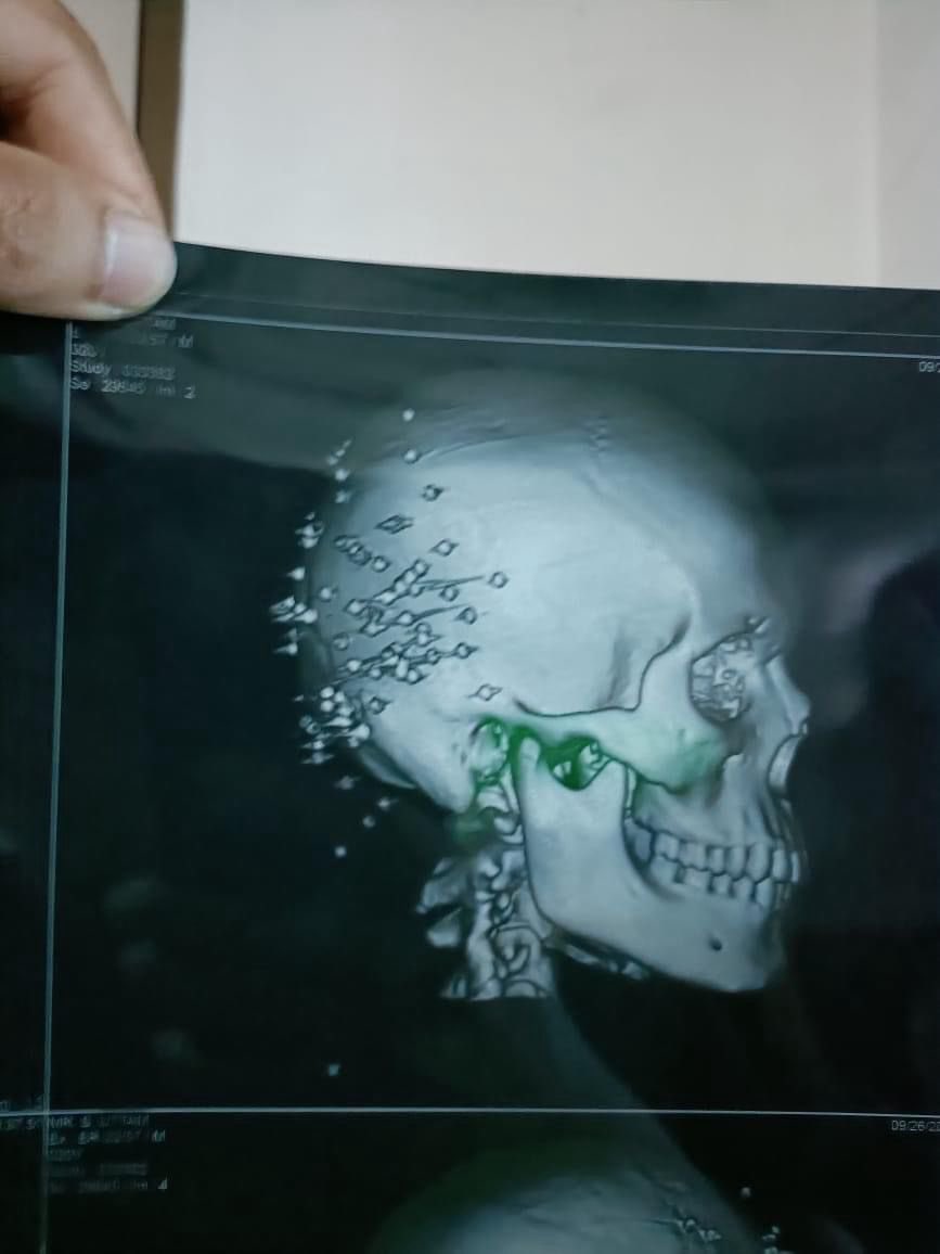 This student was brutally attacked and fired with bore gun by RAF forces and has 100+ wounds in head and body during protest. This kid is also a wushu player of Manipur. These brutal RAF and army are so unsympathetic towards Students. The picture shown is the bore gun used by