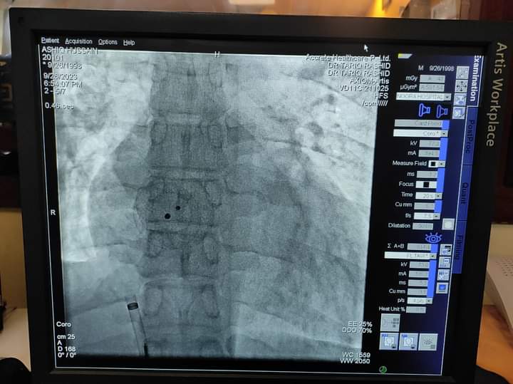 Rasiqdar08's tweet photo. #HoleInHeart #ASD #DeviceClosure
25 year old male with a large hole in heart successfully closed with a button device. Thanks to the team including Dr Mudasir Muzamil, Mr Azhar, Mr Murtaza and adm. of Noora Hospital for their support. Procedure was done free under GC.👏
Copied! https://t.co/Mts6joZU6e