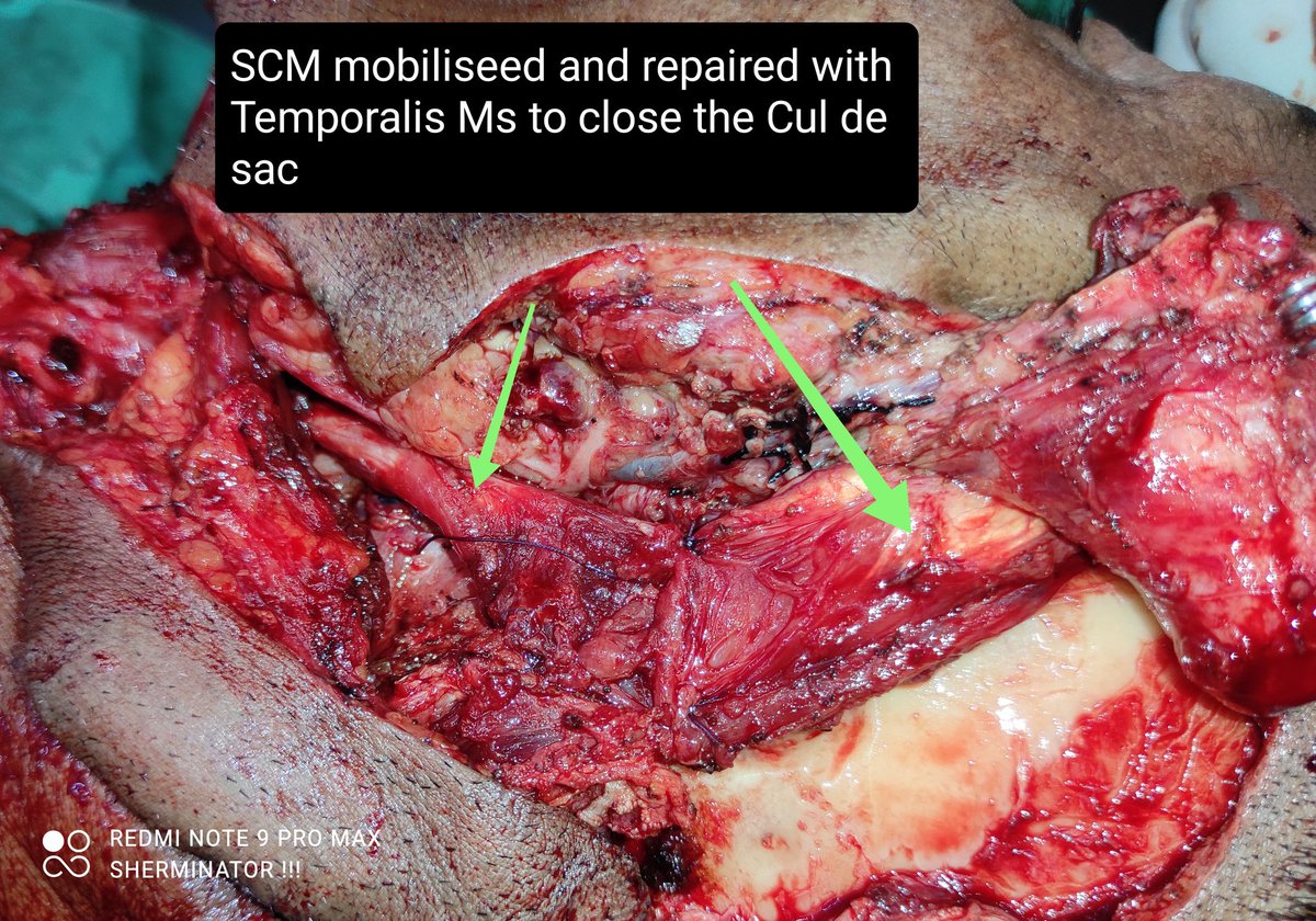 Ent_Faamch's tweet photo. Very rare and peculiar case of Temporal Bone SCC done successfully in ENT dept FAAMCH.

WLE+ Superficial Parotidectomy+ CWD Mastoidectomy+ MRND III+ Submental Flap reconstruction Surgery done in an 08 hrs duration.

@CMOfficeAssam 
@keshab_mahanta 
@FAAMCHbarpeta https://t.co/anU21dtPth