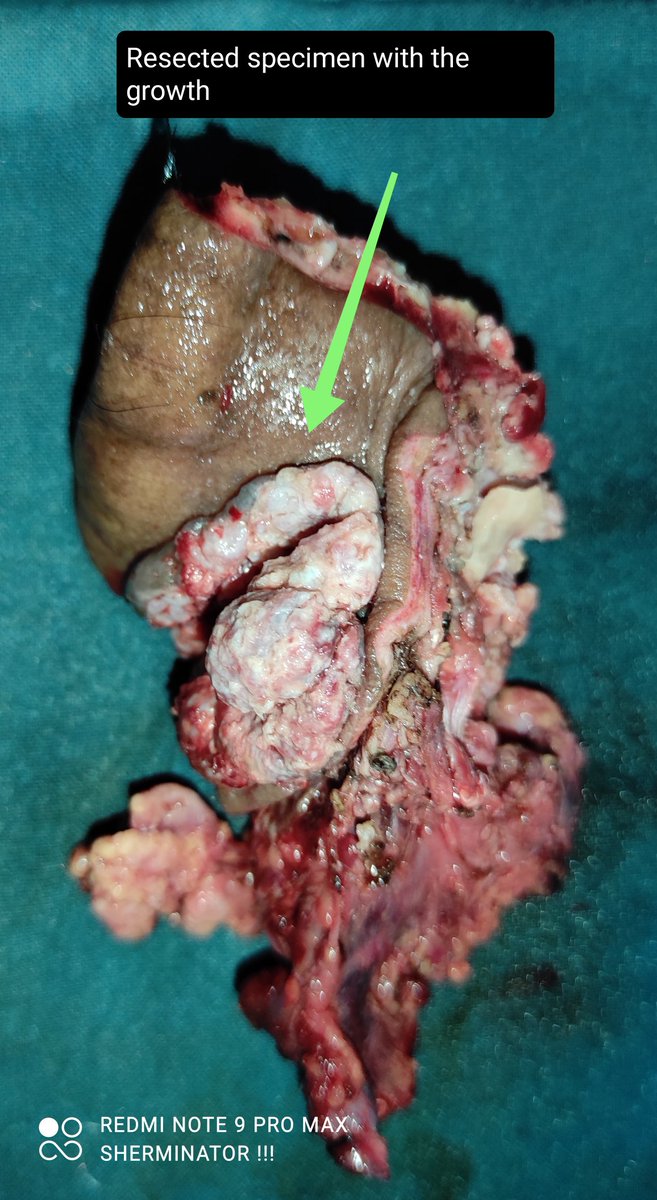 Ent_Faamch's tweet photo. Reconstruction and Post op specimen pics attached https://t.co/xeshegjgOd
