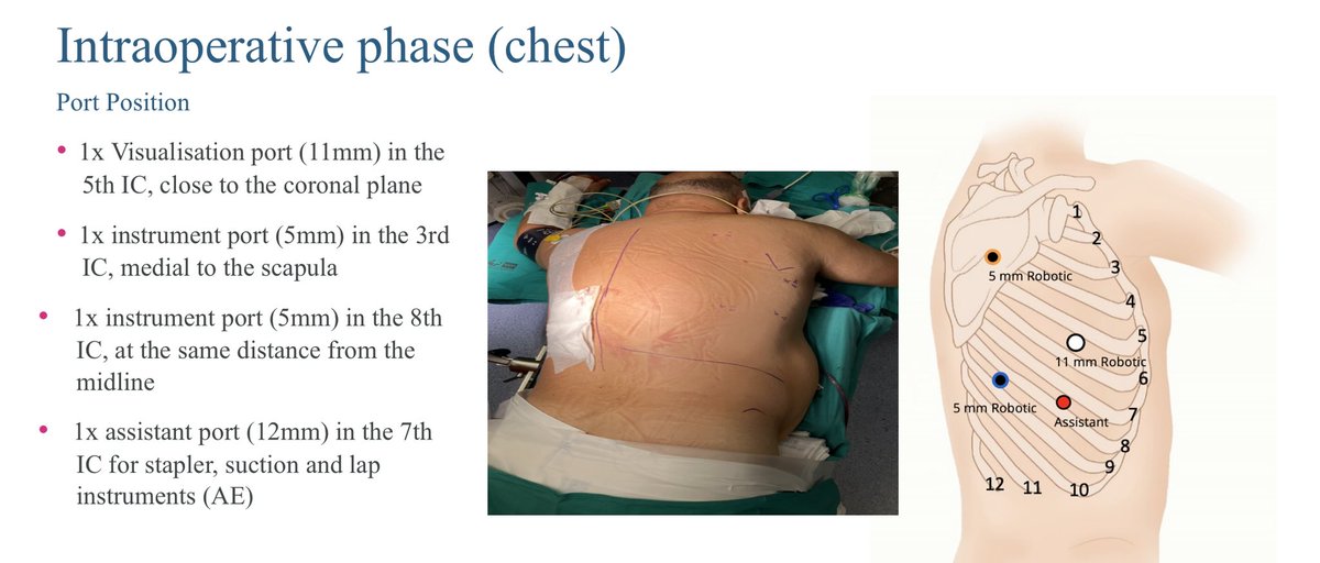 Chest docking: Fully robotic Ivor Lewis with Versius
Cirugía Esófagogastrica
Hospital Universitario Ramón y Cajal