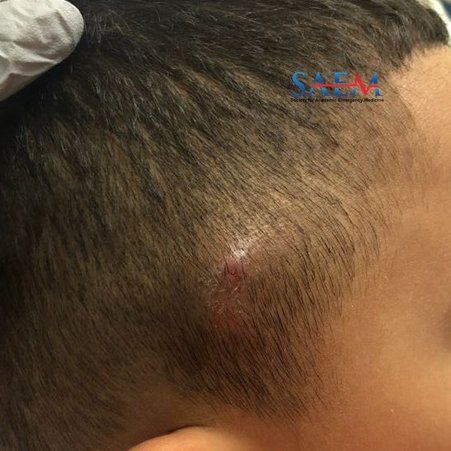SAEM Clinical Images Series: Unusual Scalp Lesions This one is a real head-scratcher. What would have been your Ddx? aliem.com/saem-clinical-… @SAEMonline