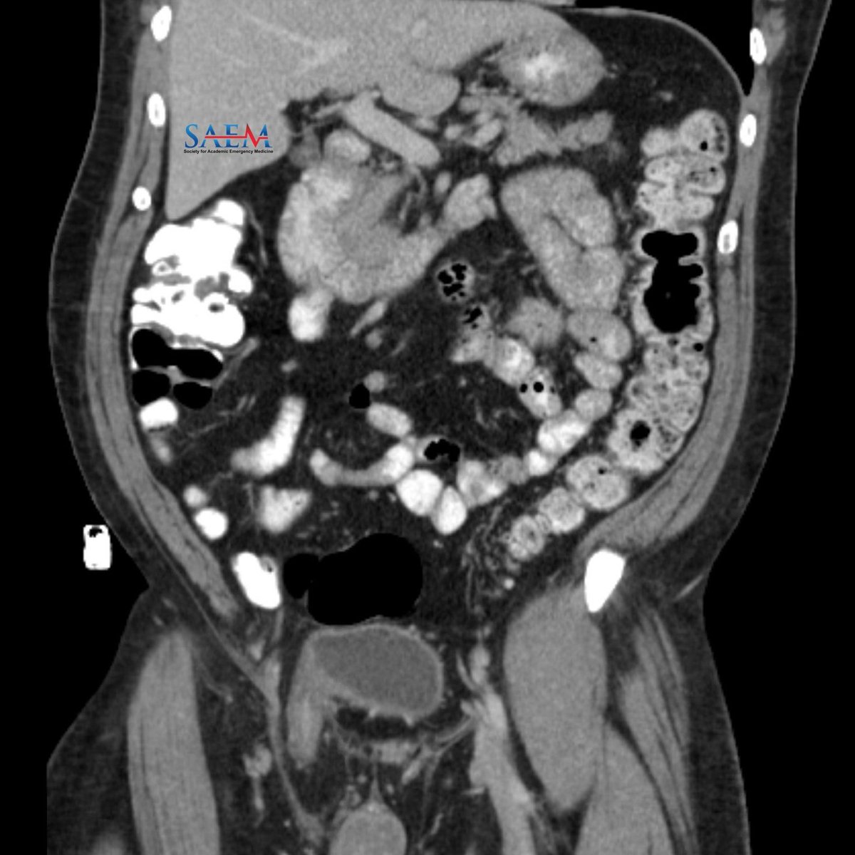 SAEM Clinical Images Series: A Rare Cause of Recurrent UTI In males with recurrent UTIs, make sure to consider diagnoses outside the abdomen. Literally. aliem.com/saem-clinical-… @SAEMonline