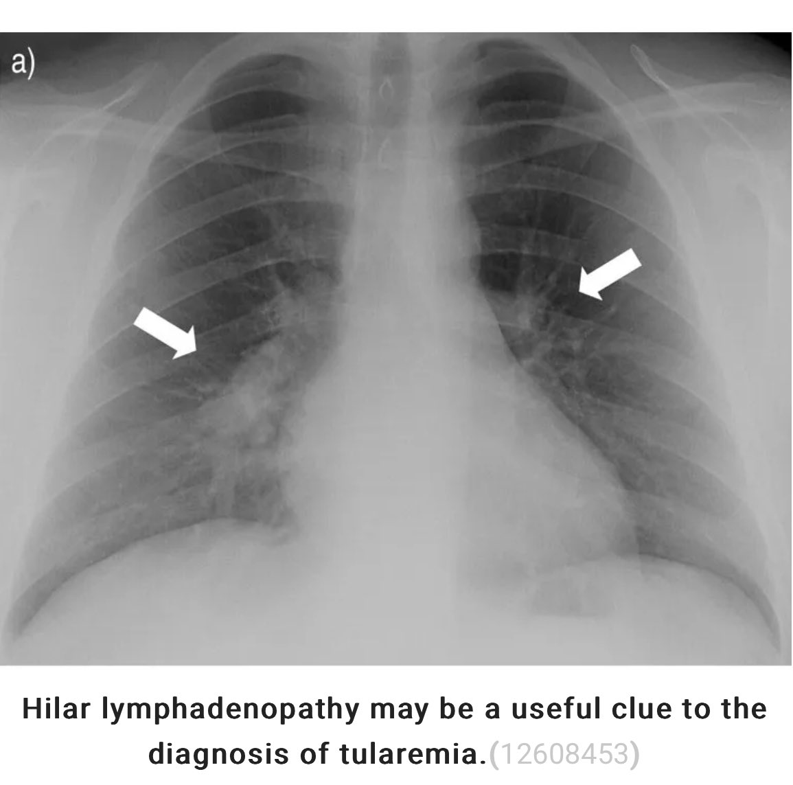 PulmCrit's tweet photo. fresh chapter: hilar &amp; mediastinal lymphadenopathy

🔍 mild swelling of a couple nodes is nonspecific, but bulky lymphadenopathy is diagnostically important

🔍distribution, imaging characteristics, &amp; context can help sort the possibilities 

https://t.co/5A410JNcTj https://t.co/54OiyvL17j