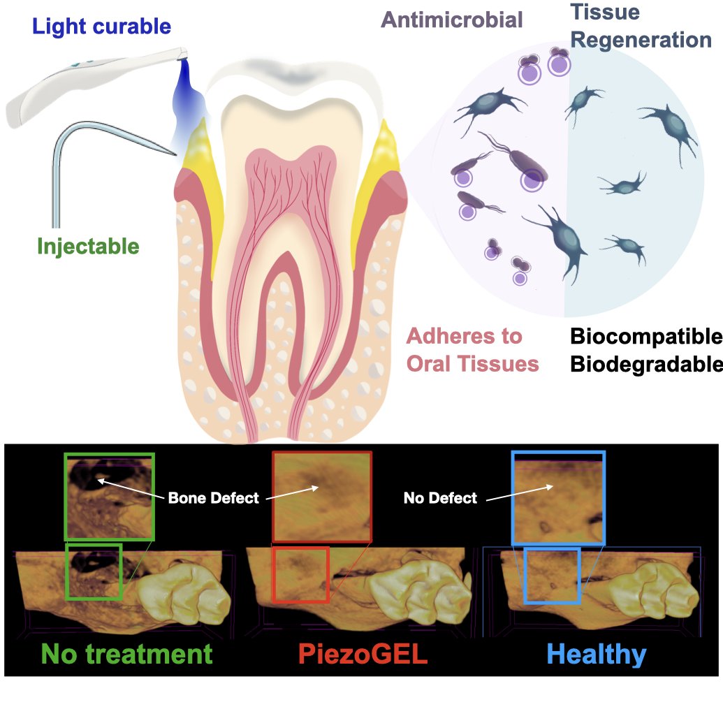 🦷Super exciting news! Our latest research work in  <a href="/ACS_AMI/">ACS Applied Materials & Interfaces</a> shows a new bioactive hydrogel for periodontal disease treatment. This injectable hydrogel combines dual antibacterial power with bone  regeneration. Dive in: shorturl.at/luvBZ