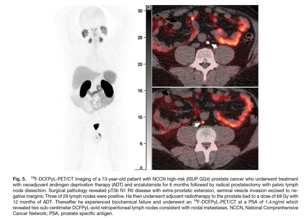 📣I am happy to share our Team's new publication "Predicting 18F-DCFPyL-PET/CT Scan Positivity in Prostate Cancer Patients with Biochemical Recurrence"  
academicradiology.org/article/S1076-… 
👍Congratulations to <a href="/KaterinaHoowon/">Katerina Hoowon Lee</a> and our amazing multi-disciplinary Team 
#prostatecancer