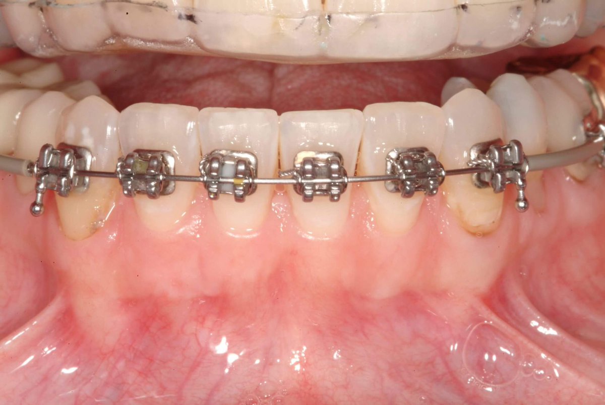 Helping Patients Understand the Duration of Orthodontic Treatment by Lee Ann Brady DMD <a href="/LeeAnnBrady/">Lee Ann Brady</a> #dentistry bit.ly/3gCZVjA