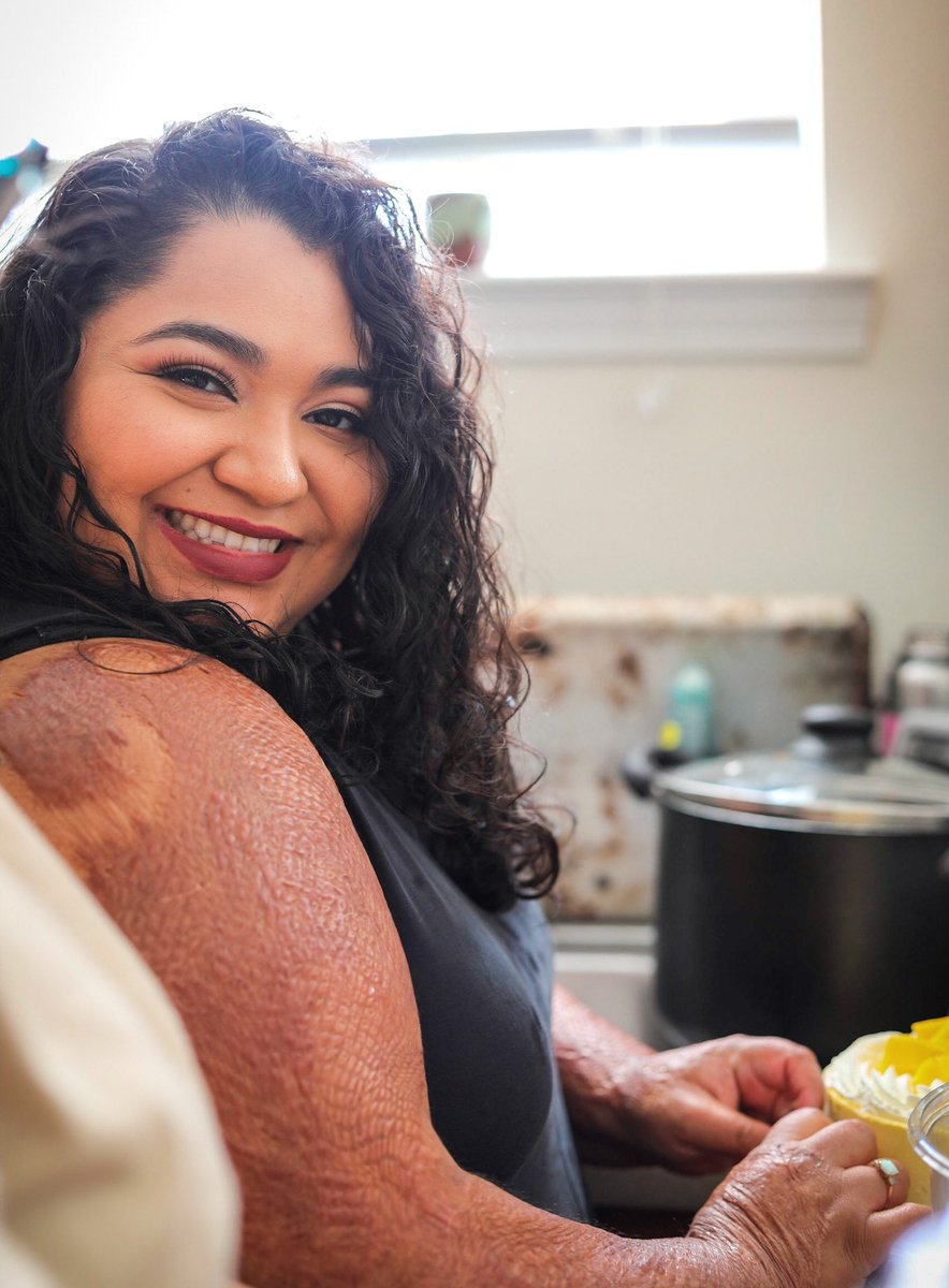 Evelin Fernandez was getting ready to prepare dinner. Two cooking spray cans sat next to the stove as they always did. Seconds later, the cans exploded. She suffered serious burns to her arms. This is Evelin's inspiring story of hope and healing. bit.ly/48xSeVo