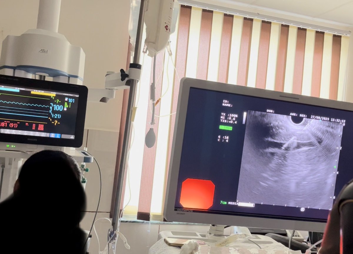 EUS-pressures… A fascinating opportunity to assess presinusoidal PHTN

HVPG 👎 here

EUS ✅
👉25G FNA💉
👉PV, f/b HV/IVC

Voila! We have true Porto-Systemic gradient

🚫need for special pressure measuring 💉
Any 💉 works with std multipara monitors

#Endohepatology #GITwitter