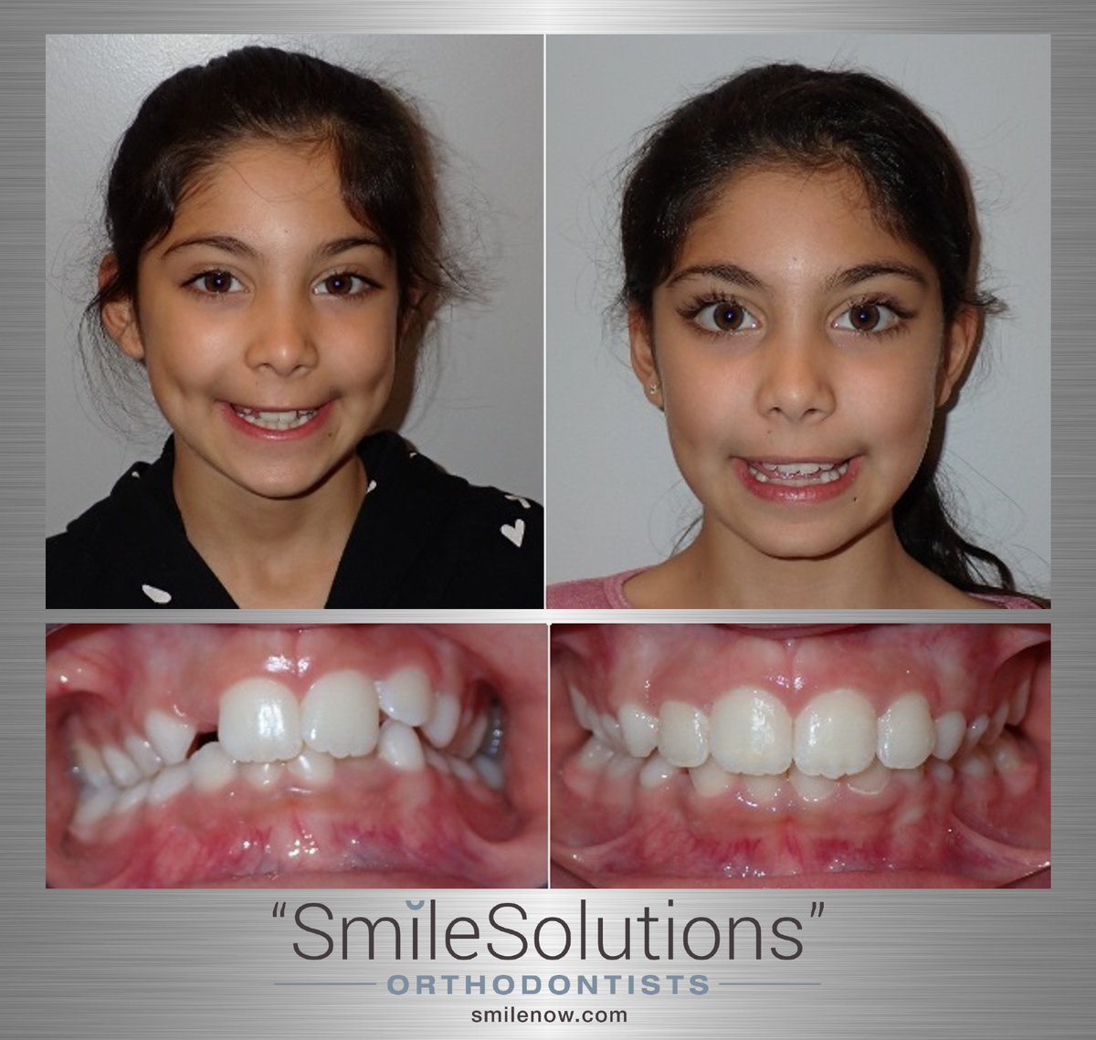 #bracesoff #bracesbrampton #bracesmississauga #smilesolutions #smilenow #invisalignbrampton #invisalignmississauga #bramptonorthodontist #mississaugaorthodontist pin.it/6lpEU7H via <a href="/pinterest/">Pinterest</a>