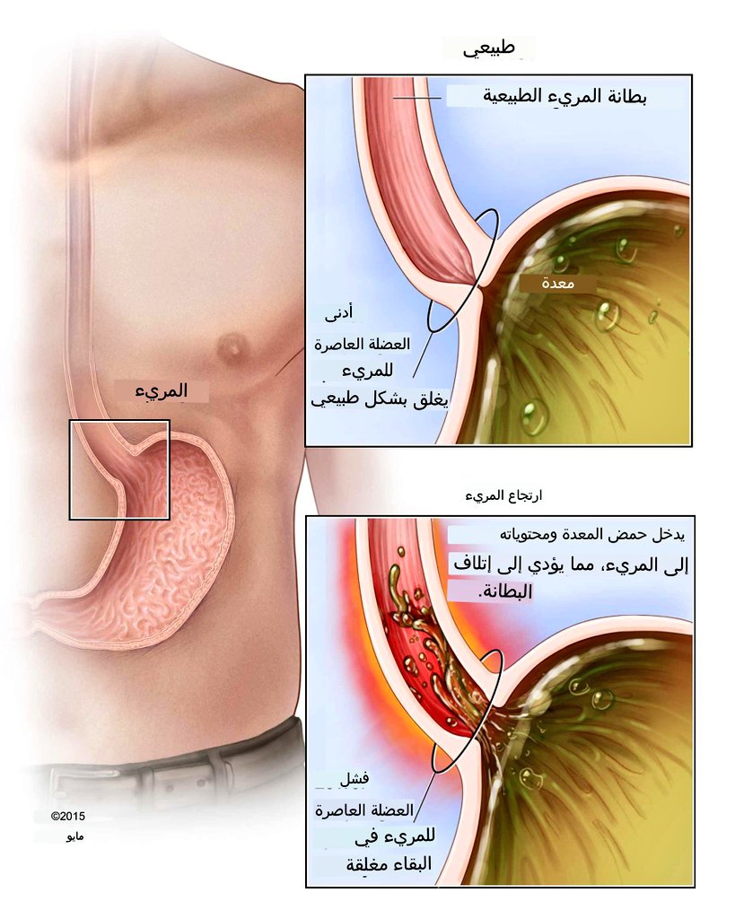 كيف يحدث الإرتجاع ودور فيتامين د فيه؟

عصارة المعدة حامضة جدا بهدف:

١. تحويل مكونات الوجبة الصلبة والقاسية إلى عجينة قبل دخولها الأمعاء.

٢. قتل الجراثيم التي في الوجبة لحماية الجسم منها.

الحموضة قوية جدا لدرجة انها تحرق أنسجة الجسم. المعدة ذاتها محمية من الحموضة بطبقة مخاطية