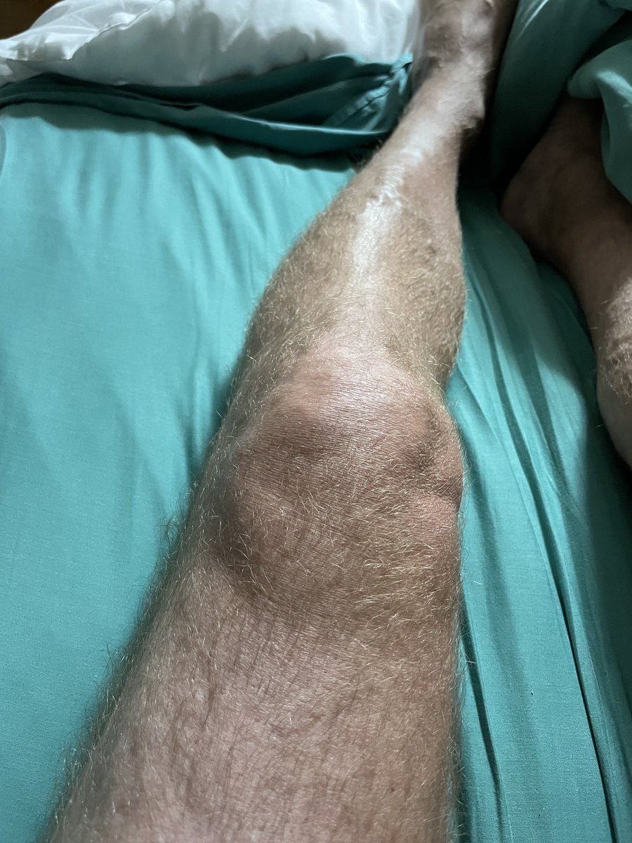 beersbythefire's tweet photo. How it started vs how it’s going. What a difference a few hours makes. Knee replacement done; back home resting. https://t.co/AzONCaXc7g