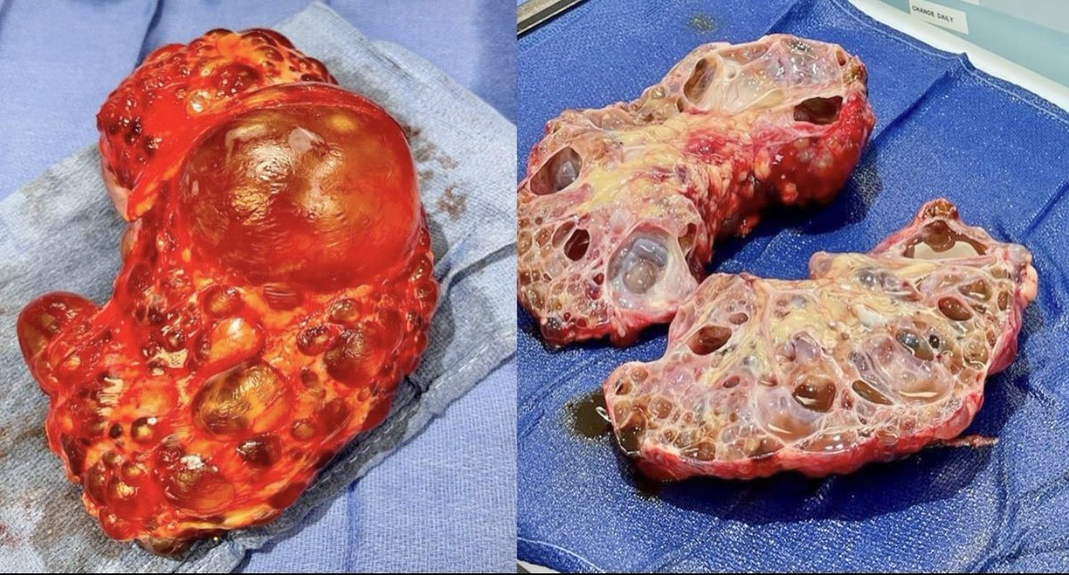 So surprised by this MASSIVE  kidney and those huge and intact cysts!🫘
 #RenalPath #PathTweeter #PathX