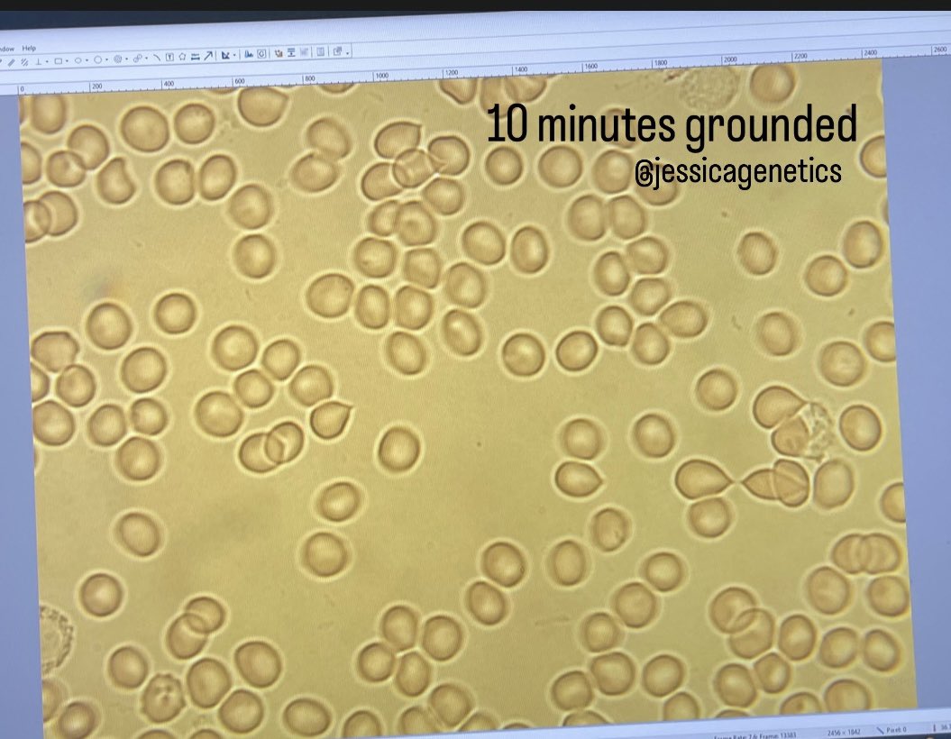 JessicaGenetics's tweet image. My conclusions:

1. Walking/circulation isn’t causing the effect we’re seeing
2. Just the act of going outside in the shade seems to offer some benefit 
3. 5 minutes of grounding barefoot on grass is enough to have an effect