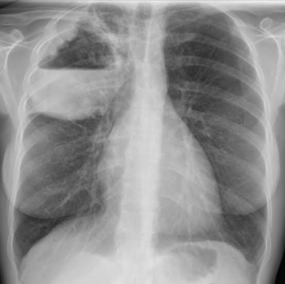 Homem, de 42 anos, com histórico de febre de alta, há 3 dias. Qual o diagnóstico?