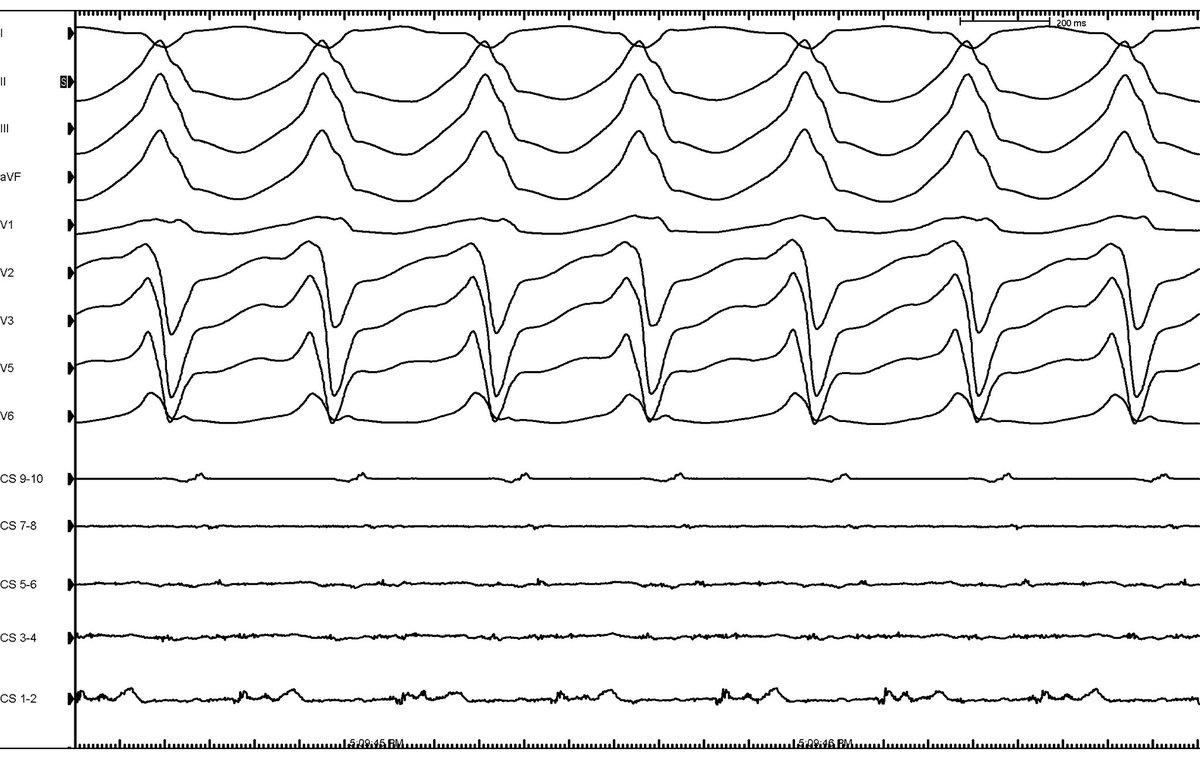 Fergie J. Losiniecki, MD, FACC, FHRS tweet media