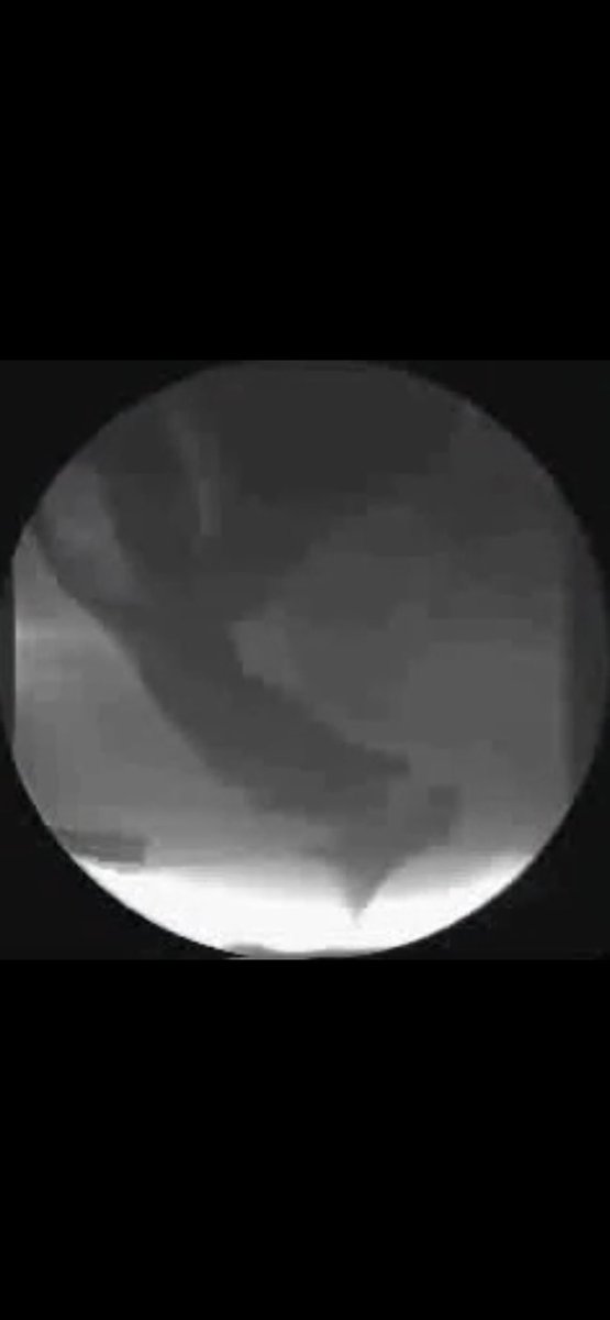 ScottRSteeleMD's tweet photo. #quickcase. Your mid 40s patient with history of two vaginal births is experiencing severe constipation and straining. Her defecography is shown. Biofeedback without change. Multiple laxatives with one BM every 2 weeks. Next steps? https://t.co/zkX8XiZx0H