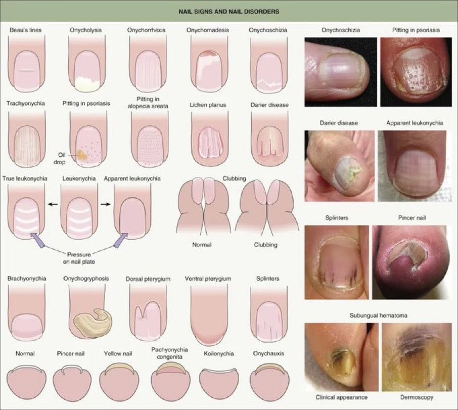 BrownJHM's tweet photo. Nail findings #MedEd (unknown source) https://t.co/Rr80eWzkEO