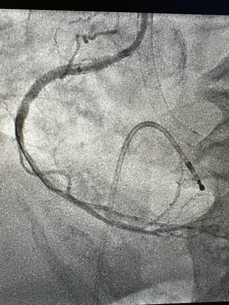 Richard Markiewicz MD (@markiewicz_md) on Twitter photo Ef 25. - Impella . Csi lm lcx shockwave to lad., Shock wave to rca. Dk crush left main <a href="/jcgeorgemd/">Jon George</a> <a href="/JanzerSean/">Sean Janzer</a> <a href="/DrAmirKaki/">Amir Kaki, MD</a> <a href="/jaygirimd/">Jay Giri</a> <a href="/DrJayMohan/">Jay Mohan, D.O., FACC, FSCAI, FASE, RPVI</a> <a href="/mmamas1973/">Mamas A. Mamas</a> Ef 25. - Impella . Csi lm lcx shockwave to lad., Shock wave to rca. Dk crush left main <a href="/jcgeorgemd/">Jon George</a> <a href="/JanzerSean/">Sean Janzer</a> <a href="/DrAmirKaki/">Amir Kaki, MD</a> <a href="/jaygirimd/">Jay Giri</a> <a href="/DrJayMohan/">Jay Mohan, D.O., FACC, FSCAI, FASE, RPVI</a> <a href="/mmamas1973/">Mamas A. Mamas</a>