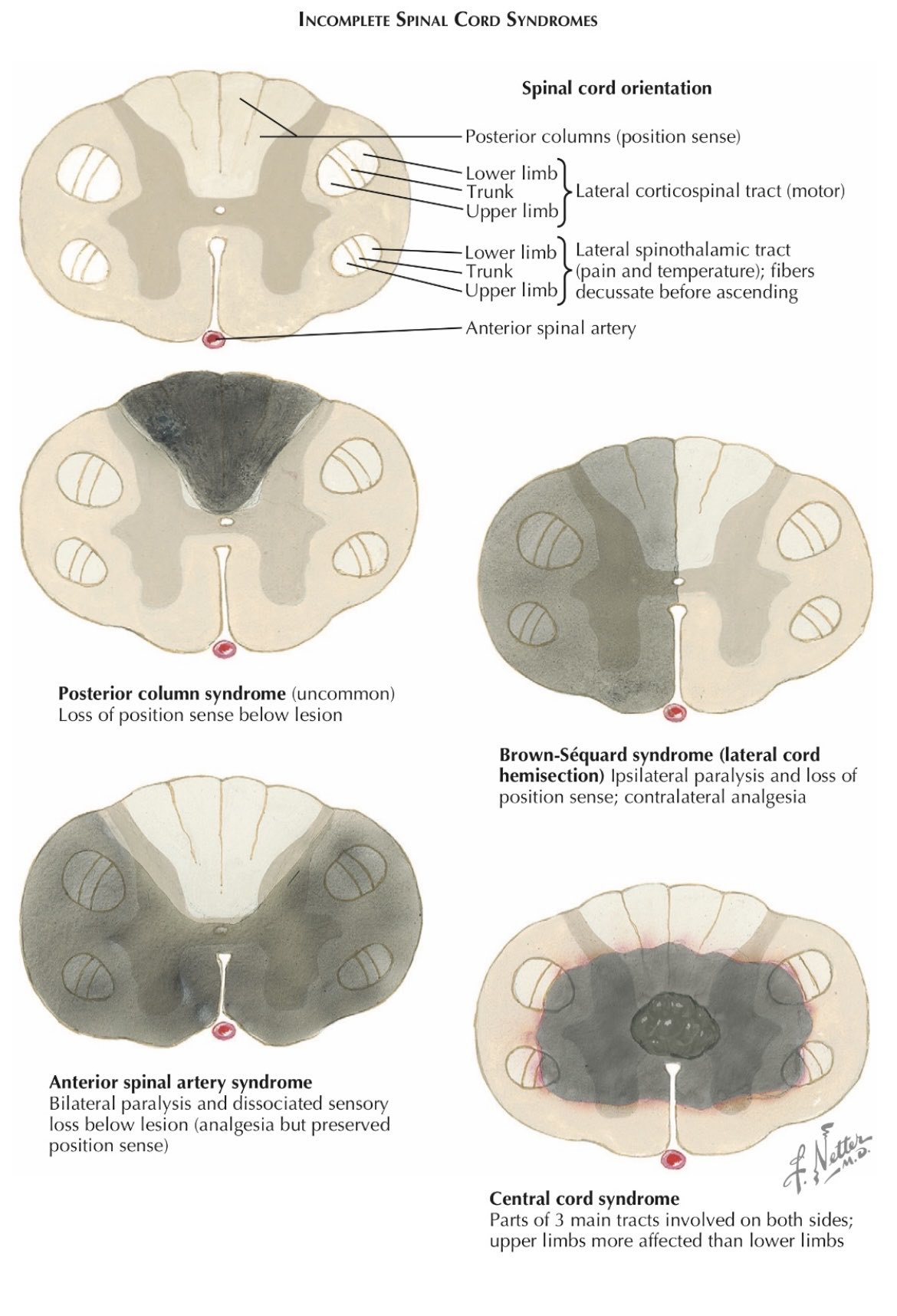 Spinal Cord Syndromes