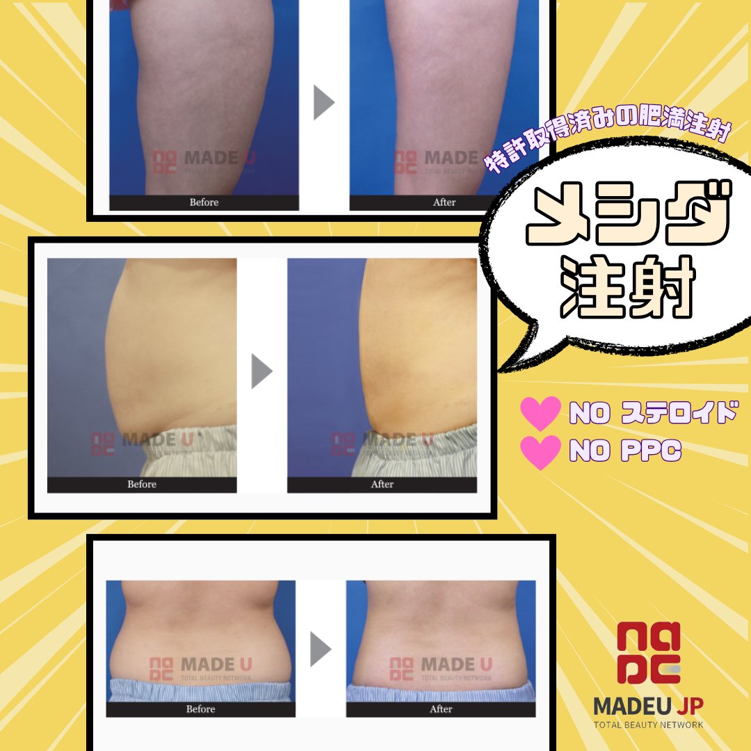 madeujp's tweet photo. 1回の施術でも効果実感🩷
特許取得済みの肥満注射 #メシダ注射
💉モニター金額
メシダS+ 132,000w
メシダD/S 275,000w
*消費税別途
#メシダ薬 と同時予約OK💊友達と一緒に来院OK👯♀️
▼予約
https://t.co/oMX51kmaTV
#メイドユー #ダイエット #ダイエット薬 #韓国ダイエット #MADEU #ダイエット注射 https://t.co/pkcu1r4mwb