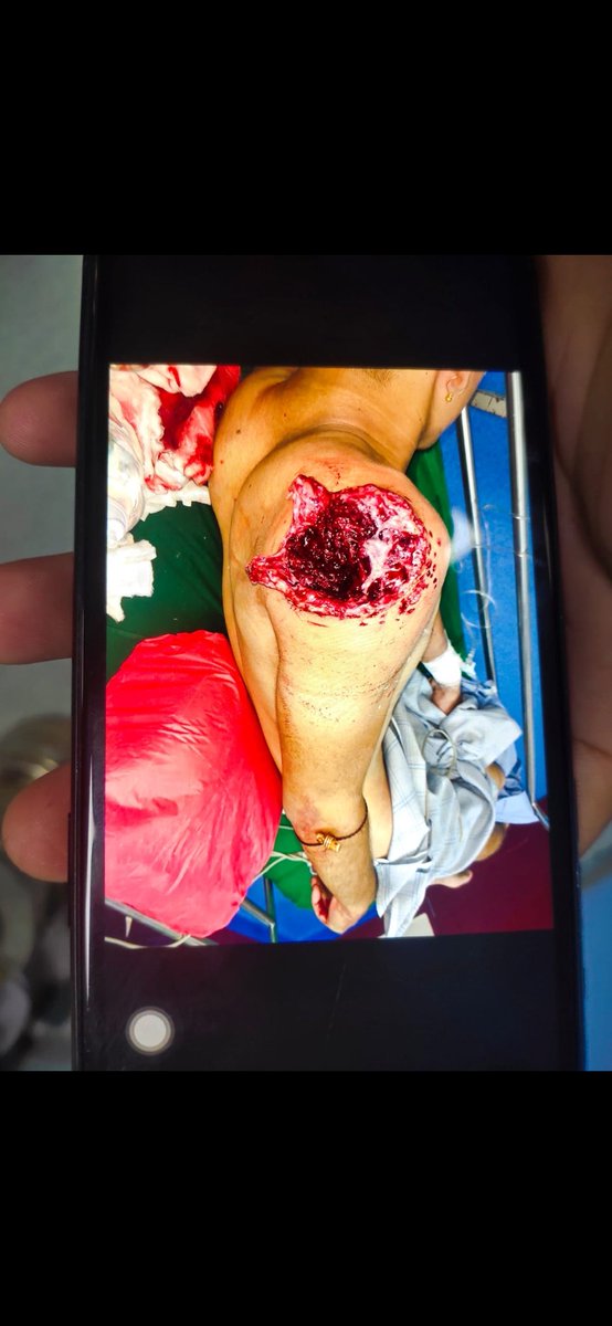 This is how the armed forces used "Minimum force" to control unarmed student protestors in Imphal while letting #KukiTerrorists roam around freely in full combat dress and guns. #ThisIsManipur.
#IndiaHorrorMuder
#JusticeForLinthoingambiAndHemanjit