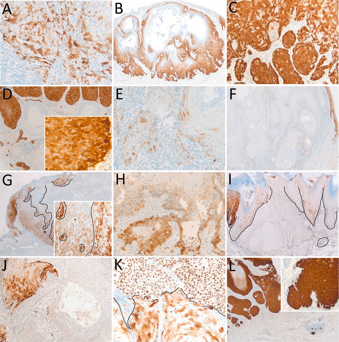 Pathology_RCPA's tweet image. Keratoacanthoma with malignant transformation may be cutaneous squamous cell carcinoma with KA-like features and might be detected more readily by routine use of p16 and p53. Read more in our 'Controversies in Pathology' series. rcpa.me/Keratoacanthoma #Pathology #MedPath