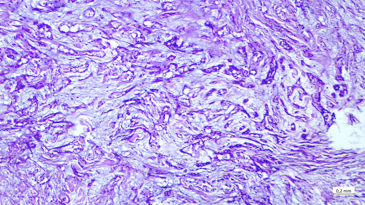edemedudy's tweet photo. Female, 57 y.o, cheek

#dermpath #pathology 
Firm pale nodule 1.5 cm in diameter https://t.co/TFPoNEtYNO