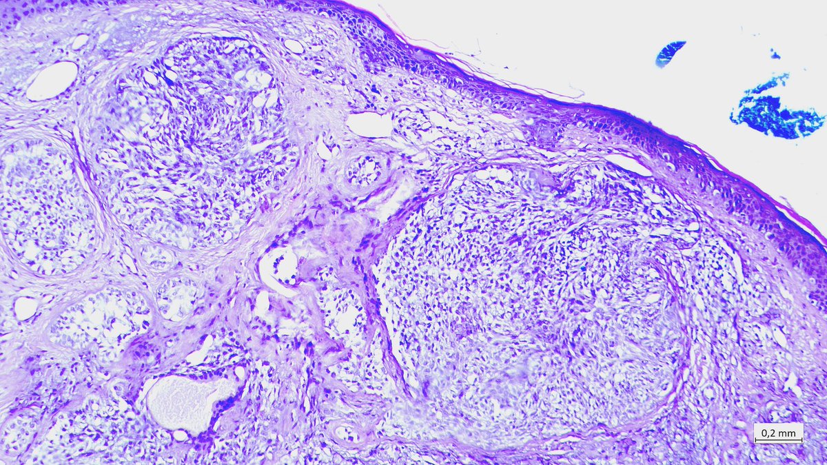 edemedudy's tweet photo. Female, 57 y.o, cheek

#dermpath #pathology 
Firm pale nodule 1.5 cm in diameter https://t.co/TFPoNEtYNO