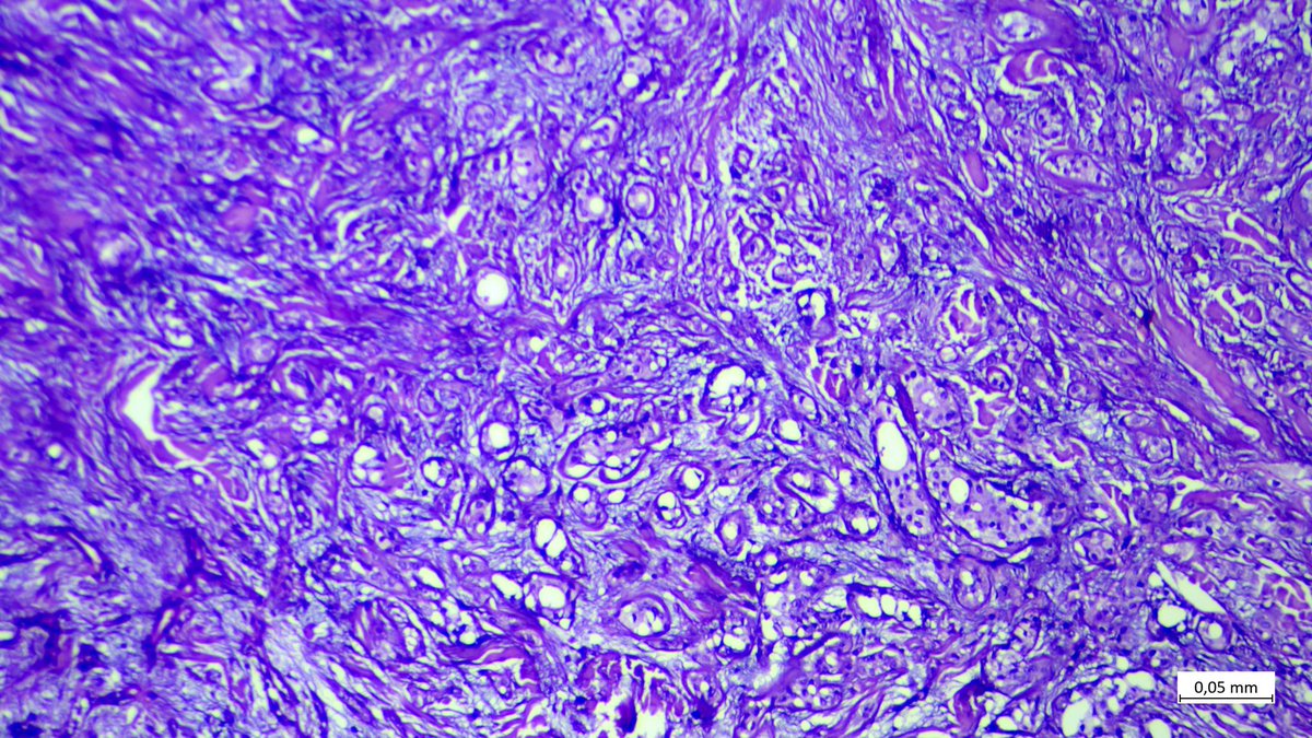 edemedudy's tweet photo. Female, 57 y.o, cheek

#dermpath #pathology 
Firm pale nodule 1.5 cm in diameter https://t.co/TFPoNEtYNO