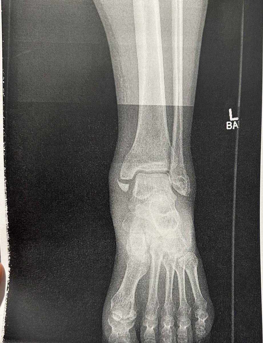RealBrittBaker's tweet photo. This guy broke his ankle in 3 places on a freak accident. He still hobbled around on live tv because as we like to say “the show must go on”.  @AdamColePro gives his entire heart and soul to pro wrestling. He’s one tough cookie and this is just a small bump in the road. He’ll be back better than ever BAYBAY 👊🏻 #AEWDynamite