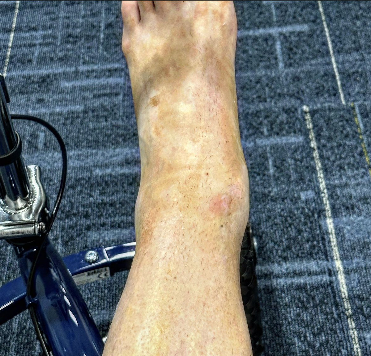 RealBrittBaker's tweet photo. This guy broke his ankle in 3 places on a freak accident. He still hobbled around on live tv because as we like to say “the show must go on”.  @AdamColePro gives his entire heart and soul to pro wrestling. He’s one tough cookie and this is just a small bump in the road. He’ll be back better than ever BAYBAY 👊🏻 #AEWDynamite