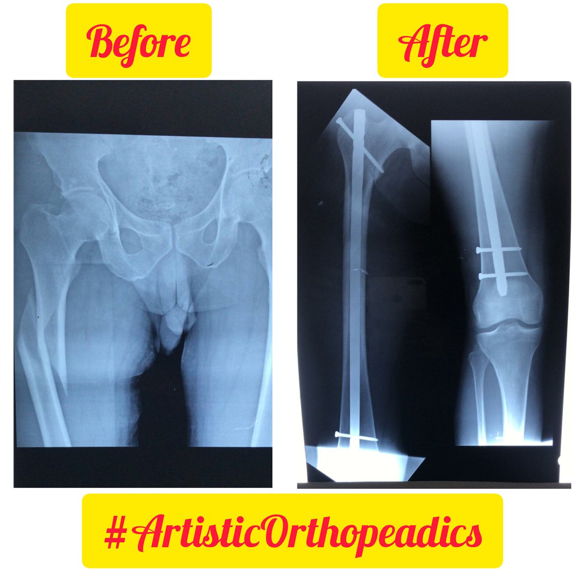 akmalzaib11's tweet photo. Art is visible when fracture become invisible.
#orthopedics
#Femurfracture
#Roadtrafficaccident
#ClosedReduction
#interlockingnail https://t.co/KrYtGkb0UY