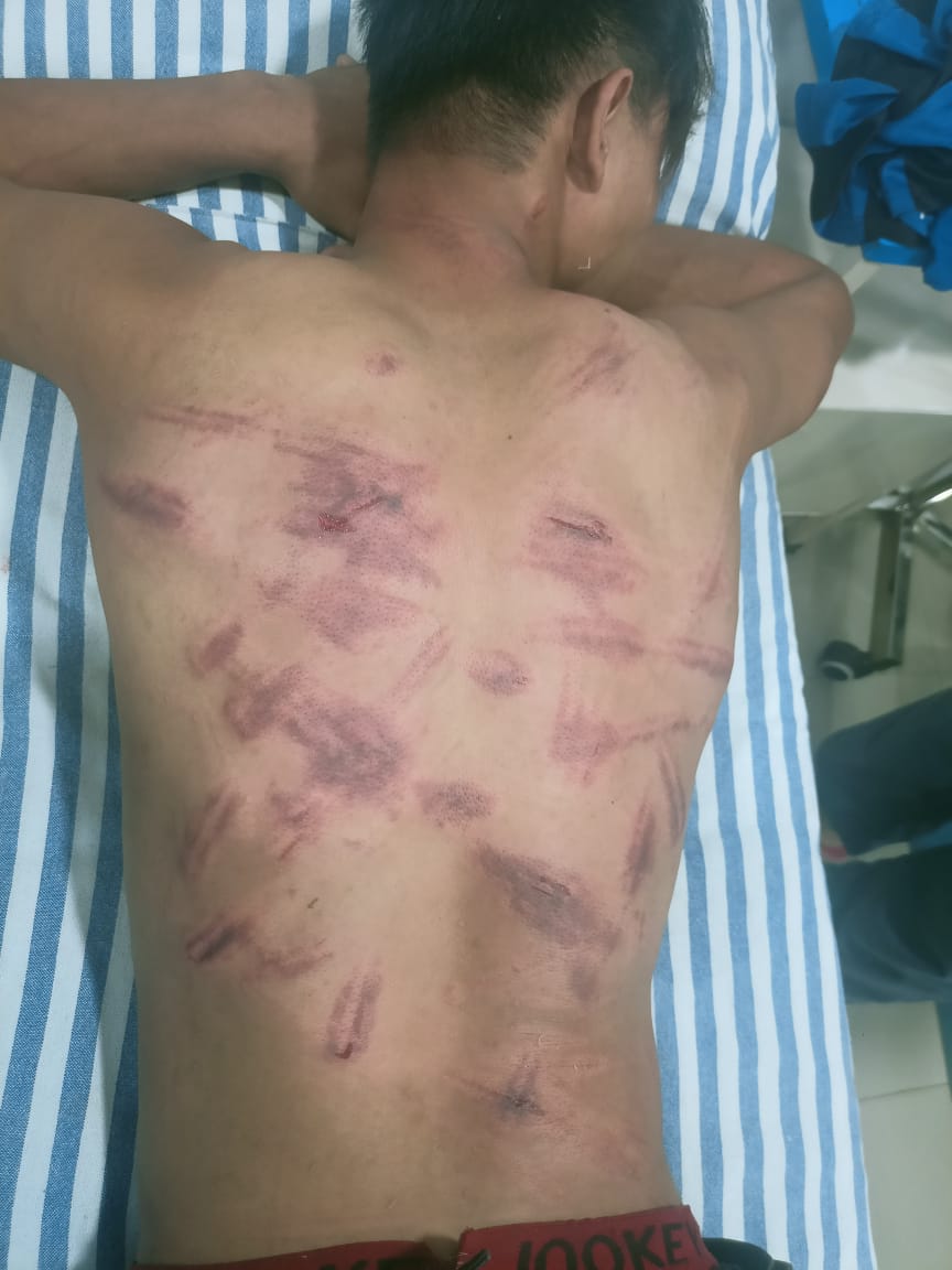 Dhiraj Luwang Vlogs (@dhiraj_luwang) on Twitter photo Another student beaten black and blue by Security Forces in Imphal!
Security Forces have been using excessive forces to control peaceful rally of students demanding justice for #LinthoingambiAndHemanjit
<a href="/Bimol_Akoijam/">A. Bimol Akoijam</a> <a href="/IndiaToday/">IndiaToday</a> <a href="/ManipurTimes/">Manipur Times</a> <a href="/MeiteiElite/">MeiteiEliteForum</a> <a href="/UN/">United Nations</a> <a href="/UNHumanRights/">UN Human Rights</a> Another student beaten black and blue by Security Forces in Imphal!
Security Forces have been using excessive forces to control peaceful rally of students demanding justice for #LinthoingambiAndHemanjit
<a href="/Bimol_Akoijam/">A. Bimol Akoijam</a> <a href="/IndiaToday/">IndiaToday</a> <a href="/ManipurTimes/">Manipur Times</a> <a href="/MeiteiElite/">MeiteiEliteForum</a> <a href="/UN/">United Nations</a> <a href="/UNHumanRights/">UN Human Rights</a>