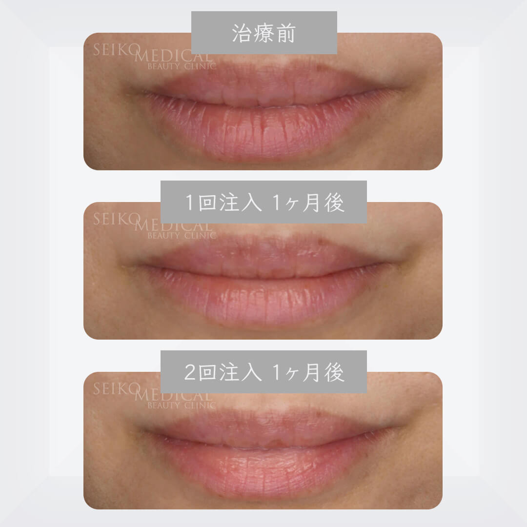 seikomedical's tweet photo. 治療結果が想像以上でびっくりしました！若返るってこういうことなのかな？

唇に対するVFD治療

詳しくはこちら✨
https://t.co/AGkxgTZDDi

#vfd療法 #唇 #改善 #エイジングケア #エイジング #アンチエイジング #リップ #美容 #美容皮膚科 #セイコメディカルビューティクリニック https://t.co/MJfvCywevf