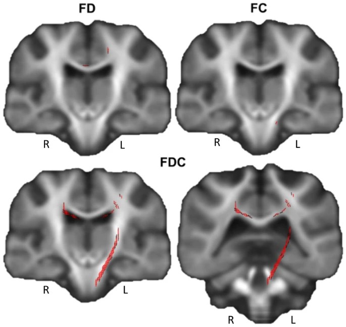 📢New publication 

🧠 What happens to the brain and cognitive performance after a COVID-19 infection? 

👀Find out the answer: rdcu.be/dndMJ

🙏Thank you to all the co-authors, participants and people who supported us along the way.