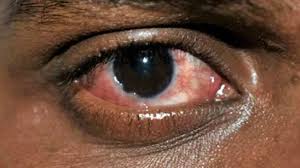 More than 70 people have suffered from blindness due to faulty injections in indifferent society of blind state.  With such height of apathy, no body is safe.
