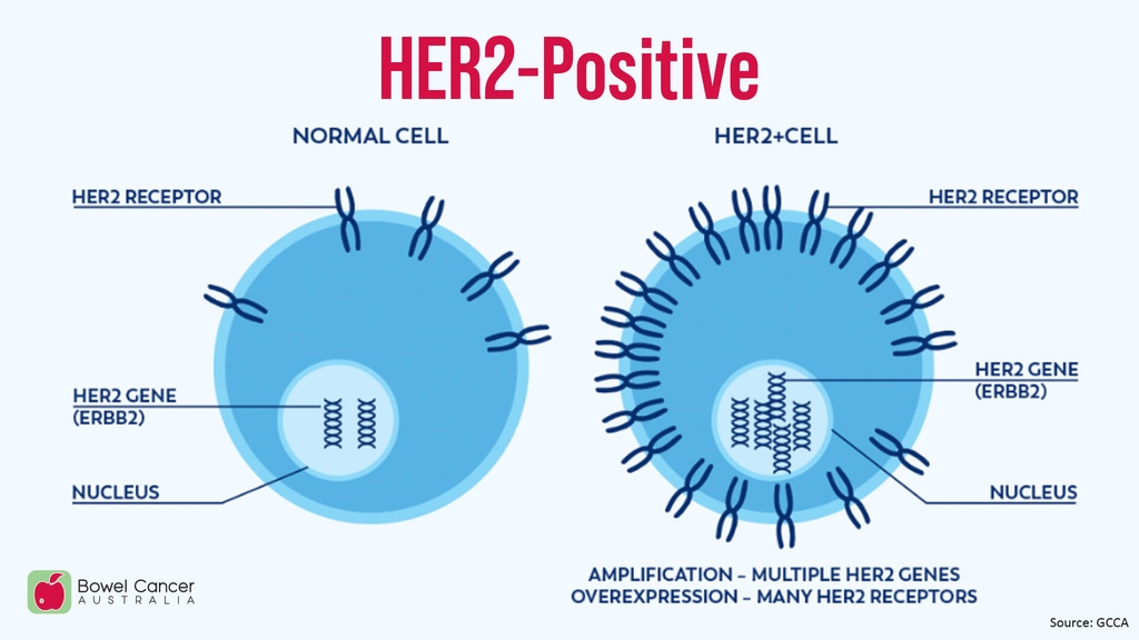 Amplification or overexpression of the #HER2 (ERBB2) gene can lead to abnormal cell growth and survival. HER2 is altered in 4.69% of #BowelCancer patients, with amplification present in 2.22%. bit.ly/3RIyYPn #WorldMCRCDay #KnowYourBiomarker
