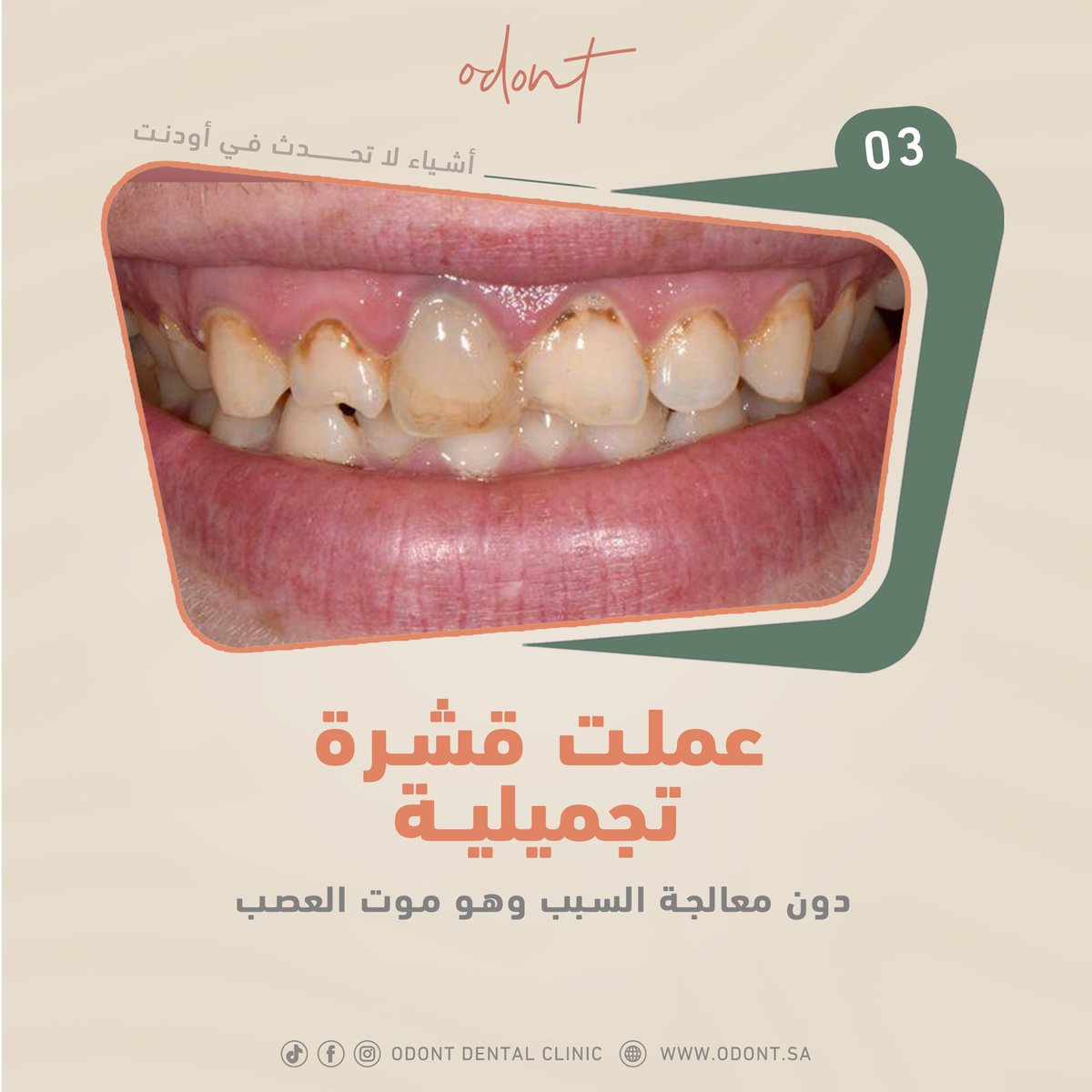 تحدث مشاكل الأسنان لأسباب عديدة، قد يكون عدم تواصل الأطباء إحداها! 
في أودنت يعمل فريق من مختلف تخصصات الأسنان معًا لتصميم خطة علاجية للوصول إلى الحل الأفضل.
#الحل_عندنا دائمًا