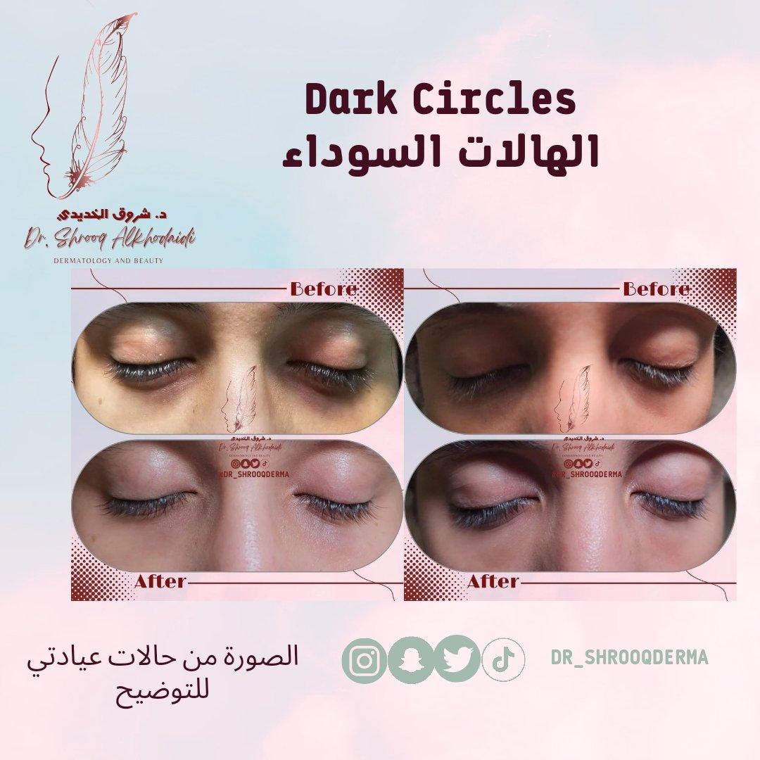 د. شروق الخديدي 🇸🇦 | جلدية وتجميل tweet media