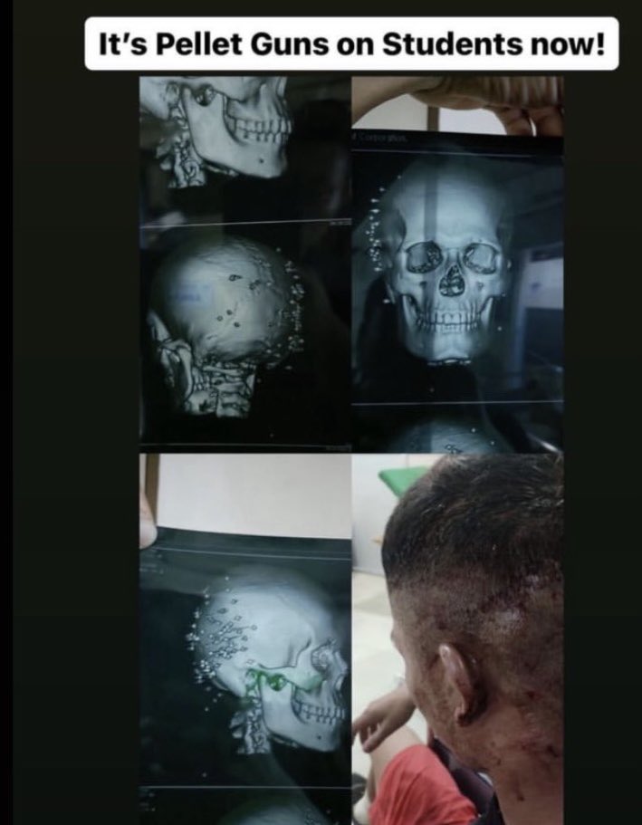 thechanu7's tweet photo. Are these photos a lie?
Is this X Ray that shows PELLETS inside bodies of the students animated?
So much for journalism ethics. Whatever the statement is from the party that has committed the crime, didn’t they ought to check facts of the reports?@the_hindu @PressCouncil_IN https://t.co/lmSKyocm4M