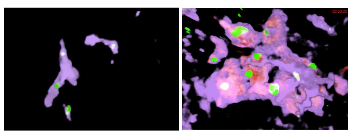 Charité - Universitätsmedizin Berlin (@chariteberlin) on Twitter photo Leberfibrose: Forschende an #CharitéBerlin und <a href="/UCalgaryMed/">UCalgaryMedicine</a> entdecken eine neue Art von Zellen. Sie beschreiben <a href="/ScienceMagazine/">Science Magazine</a>, wie das geschädigte Organ seine Immunfunktion aufrechterhält: Riesenzellen übernehmen die Aufgabe der Immunzellen der #Leber. charite.de/service/presse… Leberfibrose: Forschende an #CharitéBerlin und <a href="/UCalgaryMed/">UCalgaryMedicine</a> entdecken eine neue Art von Zellen. Sie beschreiben <a href="/ScienceMagazine/">Science Magazine</a>, wie das geschädigte Organ seine Immunfunktion aufrechterhält: Riesenzellen übernehmen die Aufgabe der Immunzellen der #Leber. charite.de/service/presse…