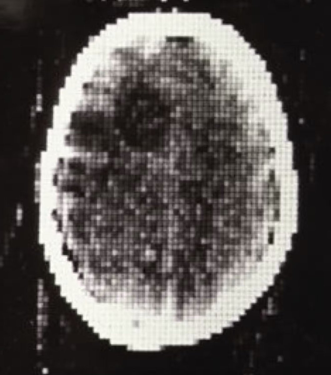 Happy 52nd birthday to the CT scan!

On this day in 1971, the first CT scan was performed in London on a novel device invented by Sir Godfrey Hounsfield and Dr. Allan Cormack.  The rest is history.