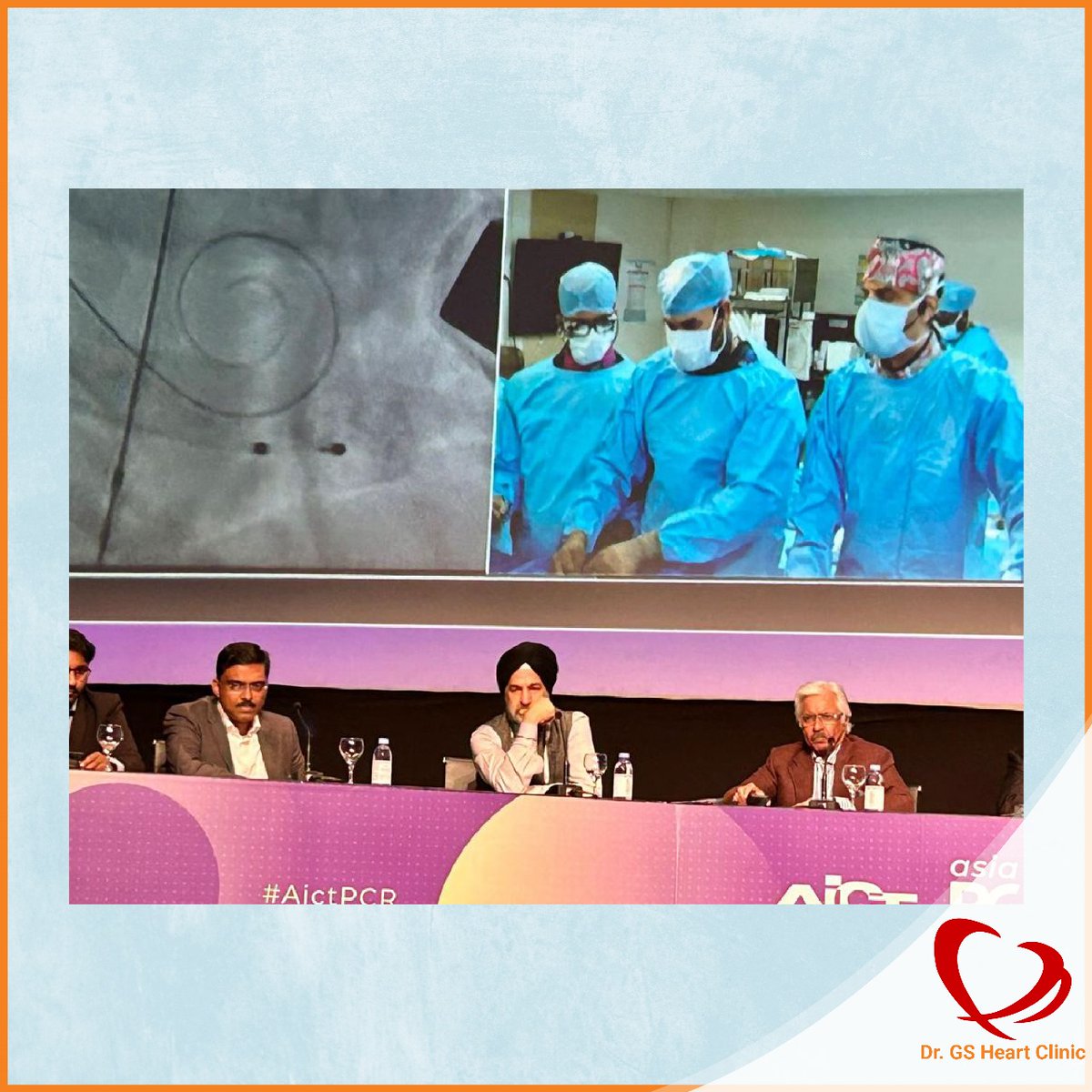 SengottuveluG's tweet image. The second case was TAVI in bicuspid valve demonstrating commissural alignment using the New gen Meril Octacor valve with excellent results. Final main gradient was 3 mm Hg with no AR, no conduction disturbances #TAVI #Rotablation #ShockWaveLithotripsy #BicuspidValve #HealthCare