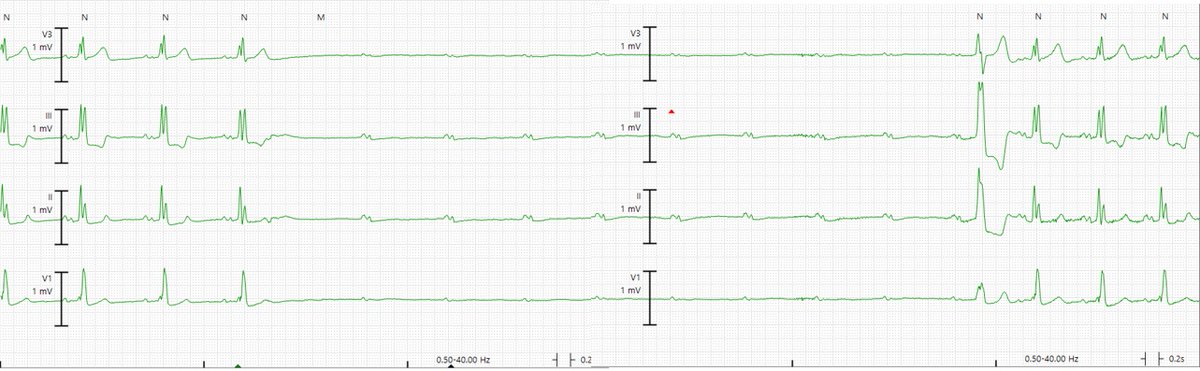 Electro-PHSYIOLOGY! Phase 4 block from PAC reset by PVC #EPeeps