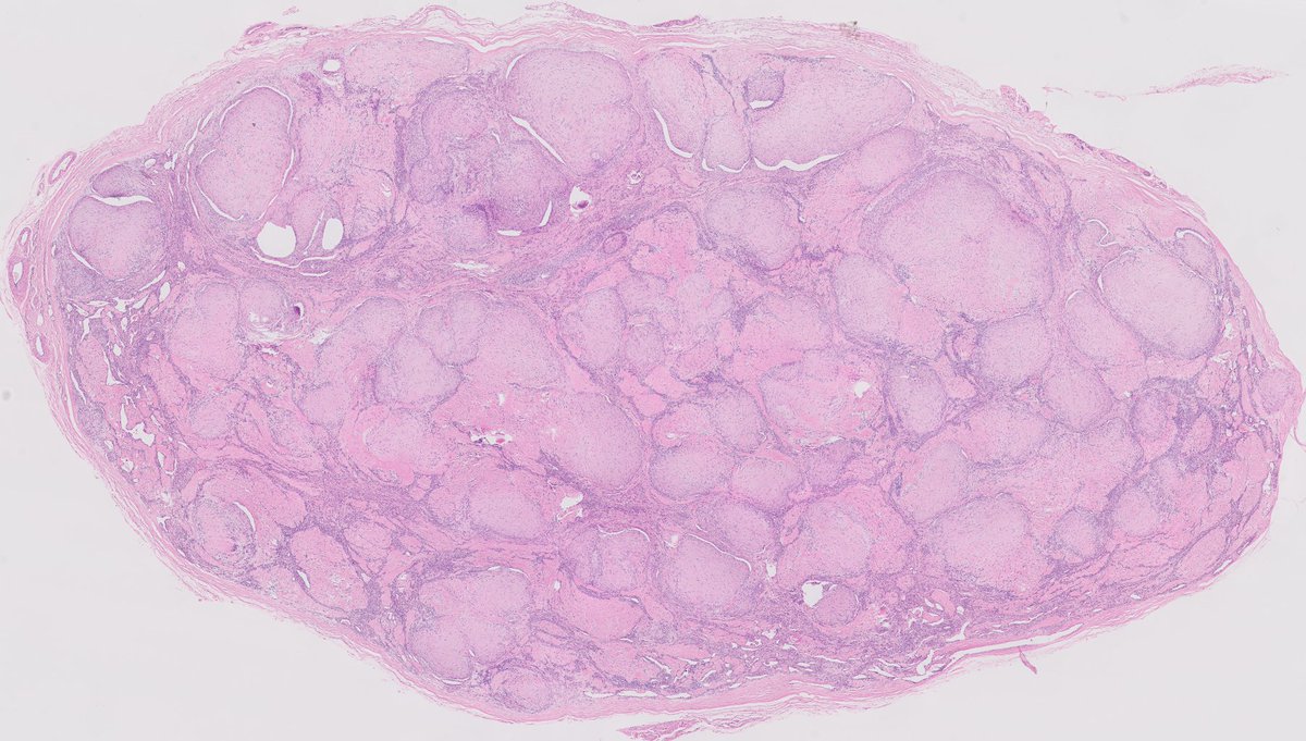 kis_lorand's tweet photo. #beautyinbenign 😁 subcutaneous lesion on the hand...you could sell it as granulomas 👇👇
#dermpath #pathology https://t.co/BzPOLLPK7o