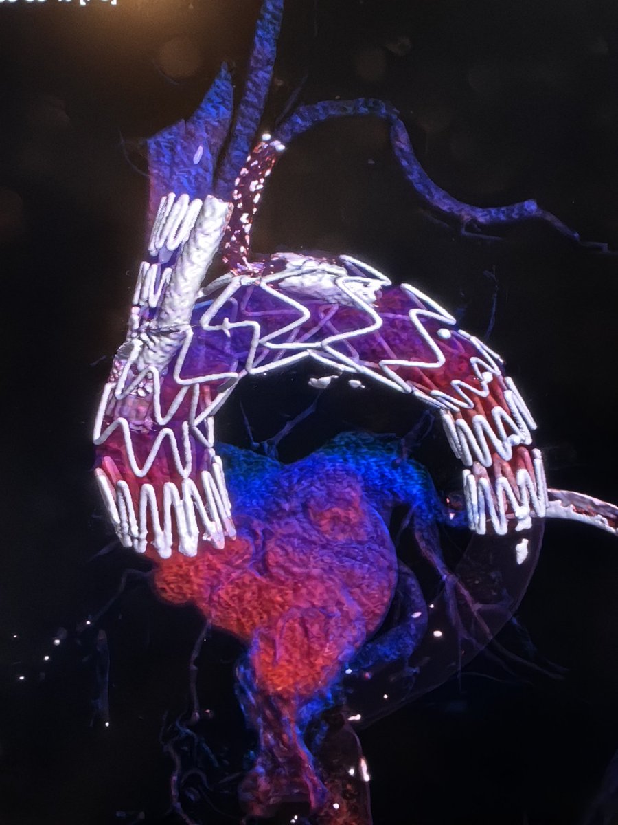 We performed our first arch bevar in Kuwait and the middle east September 2023 using cook medical custom made arch stent. Great result, happy to provide this option to patients in our area. #kuwait #endovascular